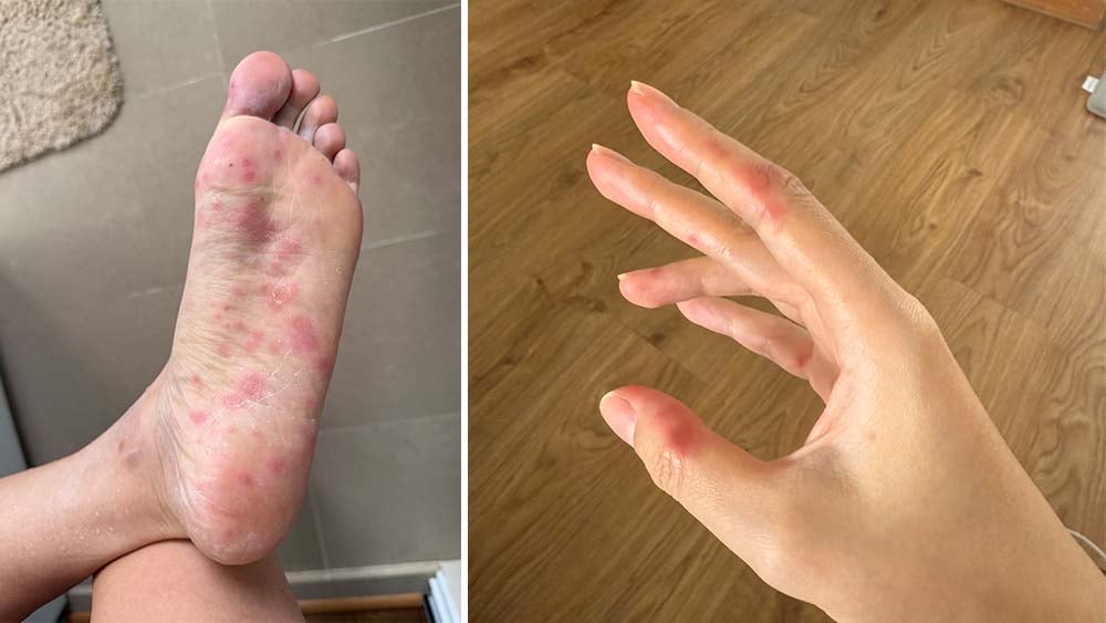 I Thought Childbirth Was Painful. Then I Caught My Baby's Hand, Foot And Mouth Disease